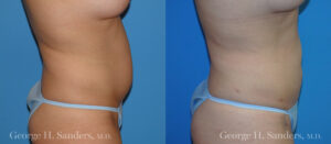 Patient 3b Liposuction Before and After