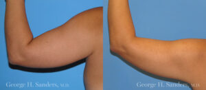 Patient 4b Liposuction Before and After