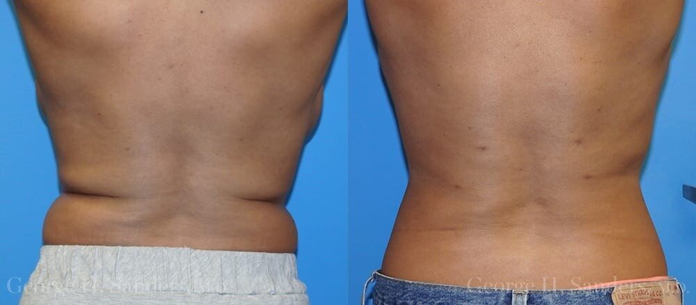 Patient 5a Liposuction Before and After