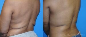 Patient 5b Liposuction Before and After