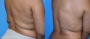 Patient 5c Liposuction Before and After
