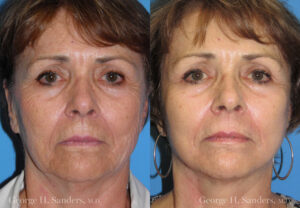 Patient 10a MACS Lift Before and After