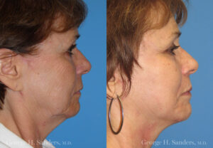 Patient 10b MACS Lift Before and After