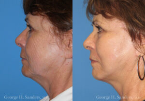 Patient 10c MACS Lift Before and After