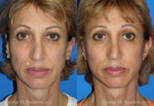 Patient 7a MACS Lift Before and After