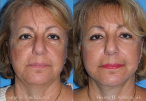 Patient 28a Laserbrasion Before and After