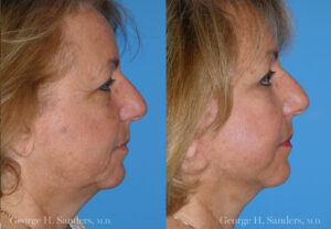 Patient 28b Laserbrasion Before and After
