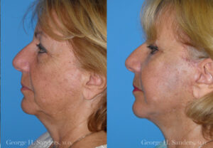 Patient 28c Laserbrasion Before and After