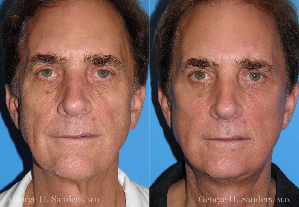 Patient 1a Male Facelift Before and After