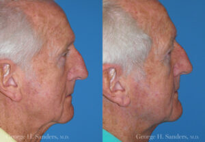 Patient 2b Male Facelift Before and After