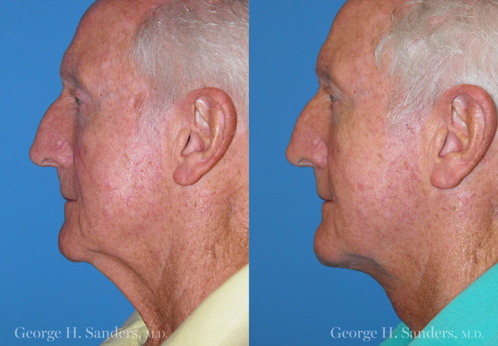 Patient 2c Male Facelift Before and After