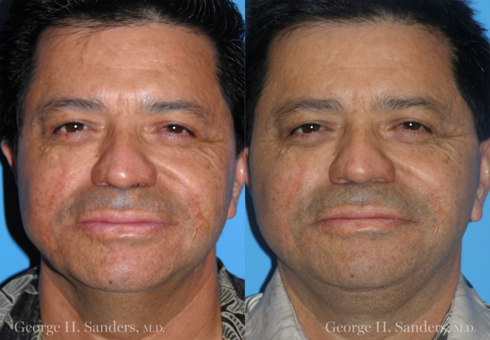 Patient 3a Male Facelift Before and After