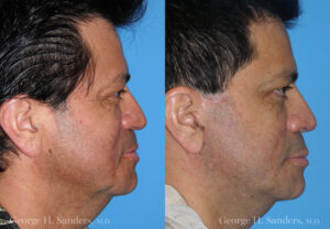 Patient 3b Male Facelift Before and After