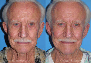 Patient 4a Male Facelift Before and After