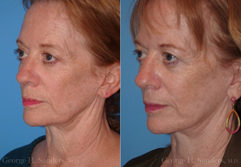 dr-sanders-san-fernando-valley-Neck-lift_Patient-13-2