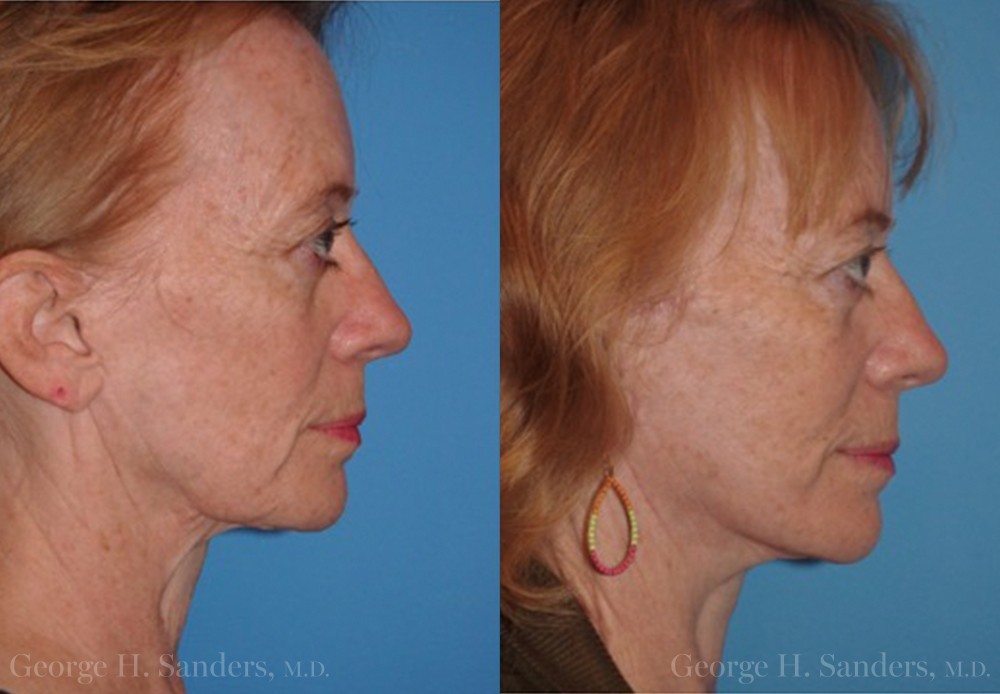 dr-sanders-san-fernando-valley-Neck-lift_Patient-13-3