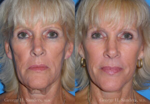 Patient 10b Neck Lift Before and After