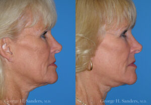 Patient 10a Neck Lift Before and After