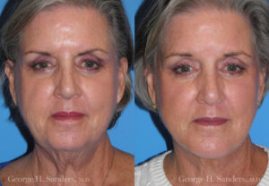 Patient 11c Neck Lift Before and After