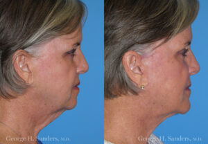 Patient 11b Neck Lift Before and After