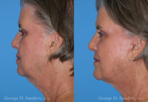 Patient 11a Neck Lift Before and After