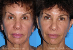 Patient 12c Neck Lift Before and After