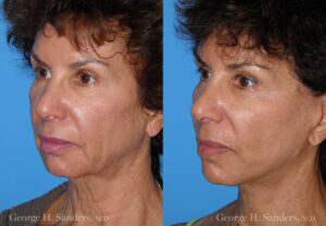 Patient 12b Neck Lift Before and After