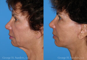 Patient 12a Neck Lift Before and After