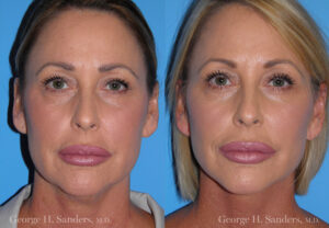 Patient 2c Neck Lift Before and After