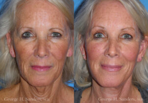Patient 3a Neck Lift Before and After