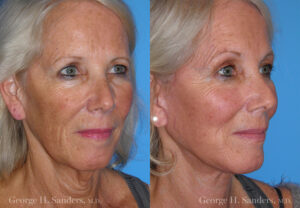 Patient 3b Neck Lift Before and After