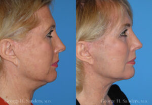 Patient 4c Neck Lift Before and After