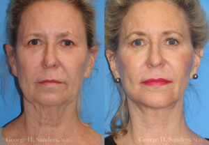 Patient 5c Neck Lift Before and After