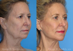 Patient 5b Neck Lift Before and After