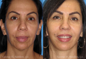 Patient 7b Neck Lift Before and After