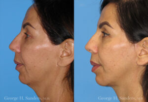 Patient 7a Neck Lift Before and After