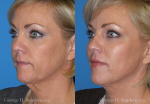 Patient 30b Laserbrasion Before and After