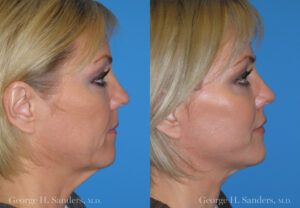 Patient 30c Laserbrasion Before and After