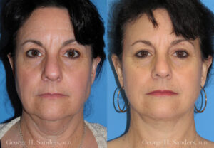 Patient 9c Neck Lift Before and After