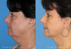 Patient 9a Neck Lift Before and After