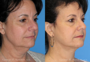 Patient 9b Neck Lift Before and After