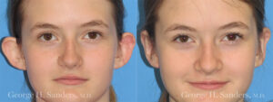 Patient 1a Otoplasty Before and After