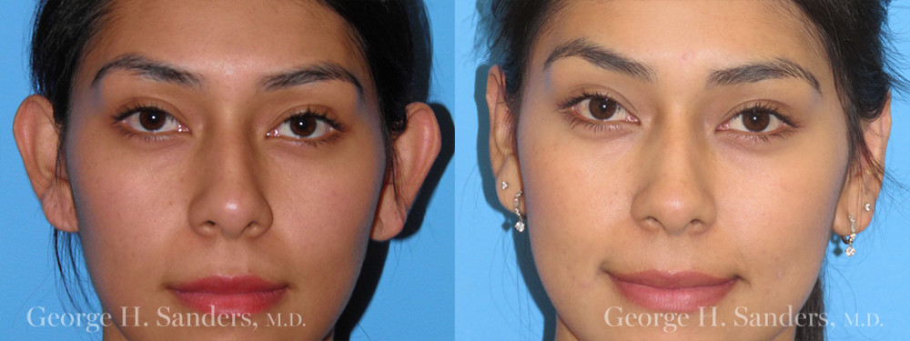 Patient 2a Otoplasty Before and After