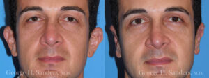 Patient 3a Otoplasty Before and After