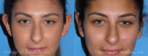 Patient 4a Otoplasty Before and After