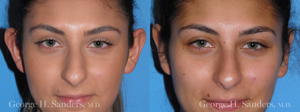 Patient 4a Otoplasty Before and After