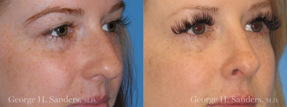 Patient 1b Rhinoplasty Before and After