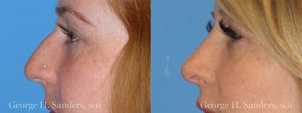 Patient 1a Rhinoplasty Before and After