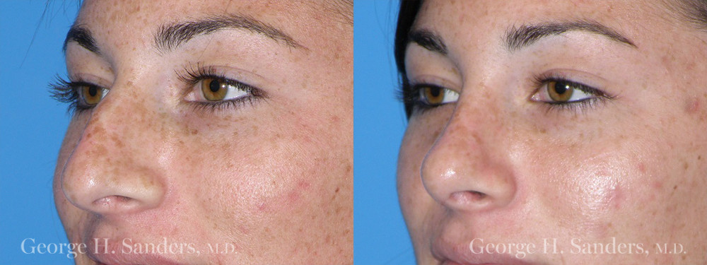 Patient 10a Rhinoplasty Before and After