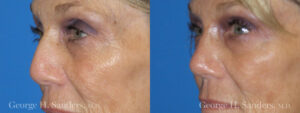 Patient 13b Rhinoplasty Before and After